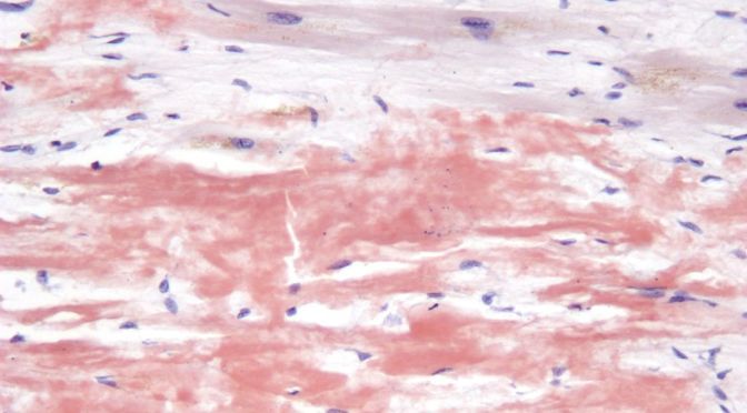 Amiloidosis Heredofamiliar: enfermedad que impacta a familias en México